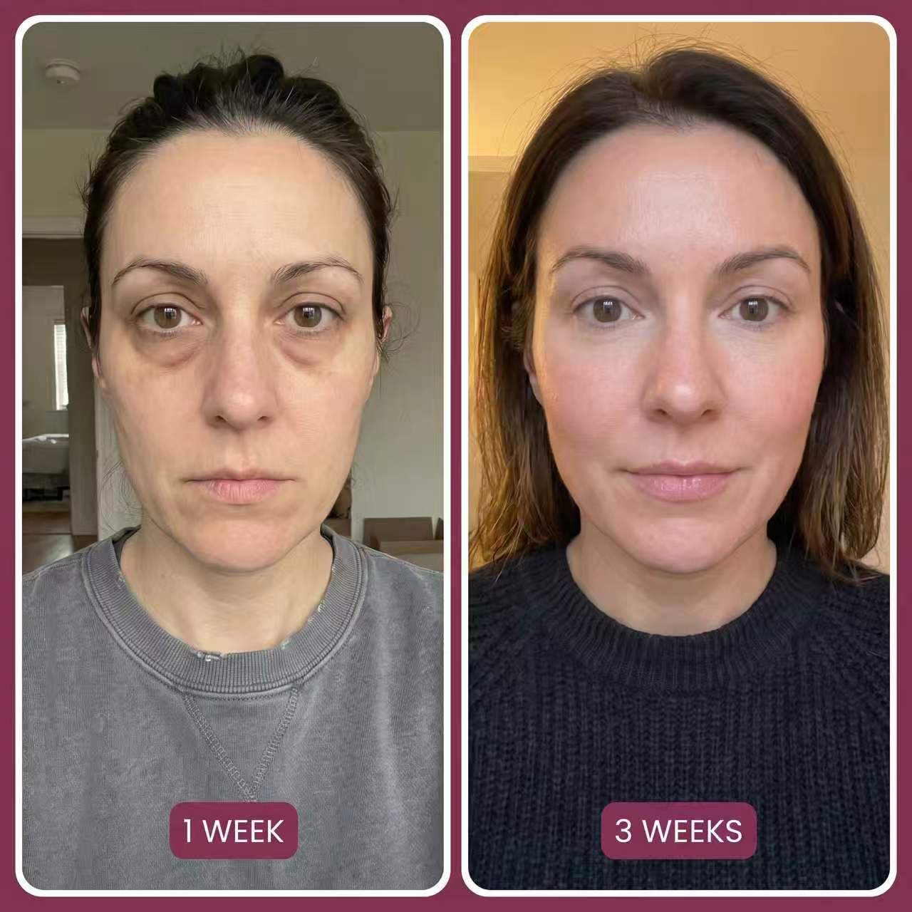 Target Neck Lines, Crepey Skin & Loss of Firmness.
